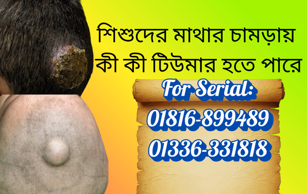 বাংলাদেশে শিশুদের মাথার চামড়ার বিভিন্ন টিউমার ও গুটির লক্ষণ এবং চিকিৎসা