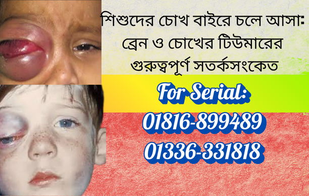 ব্রেন ও চোখের টিউমারের কারণে শিশুদের চোখ বাইরে চলে আসার লক্ষণ ও চিকিৎসা