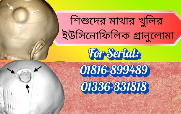 বাংলাদেশে শিশুদের মাথার খুলির ইউসিনোফিলিক গ্রানুলোমার লক্ষণ ও চিকিৎসা